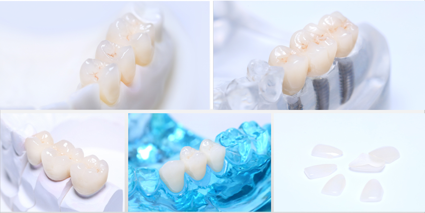Zirconia Crown&Bridge(图1)